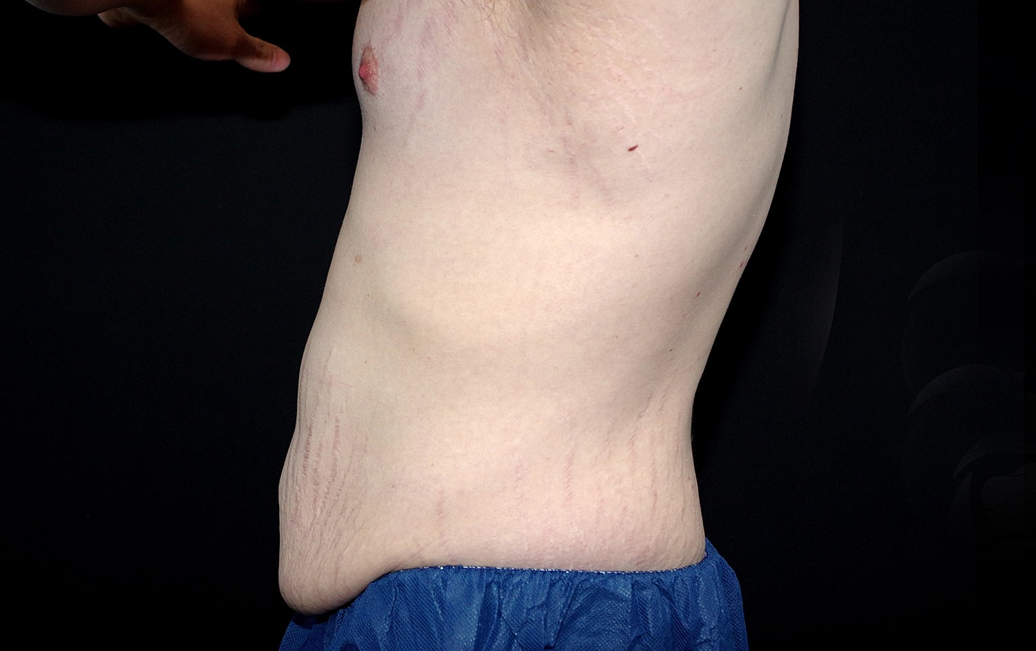Tummy Tuck Before & After