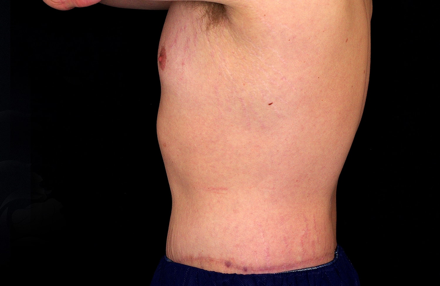 Tummy Tuck Before & After