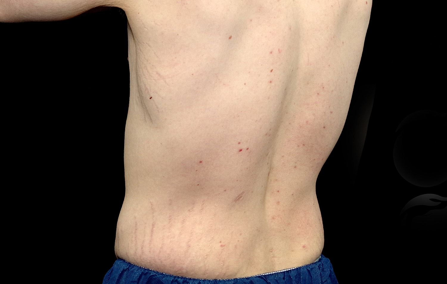 Tummy Tuck Before & After
