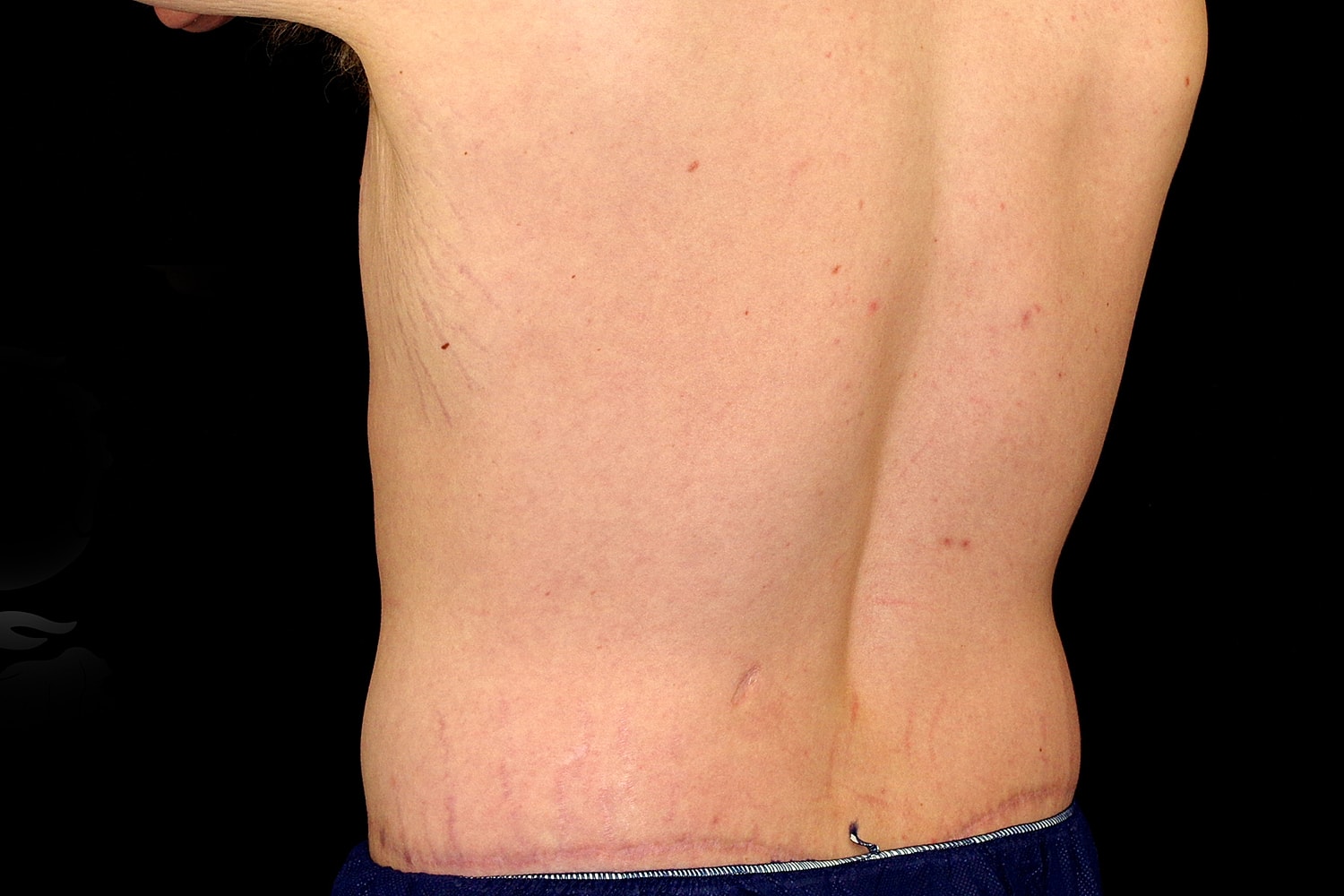 Tummy Tuck Before & After