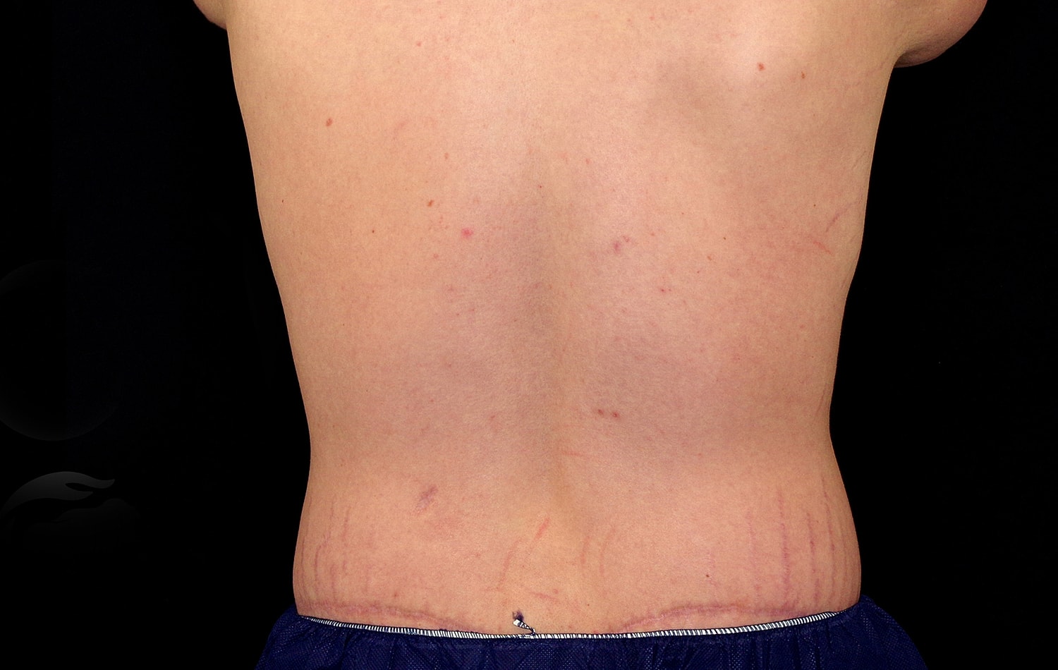Tummy Tuck Before & After