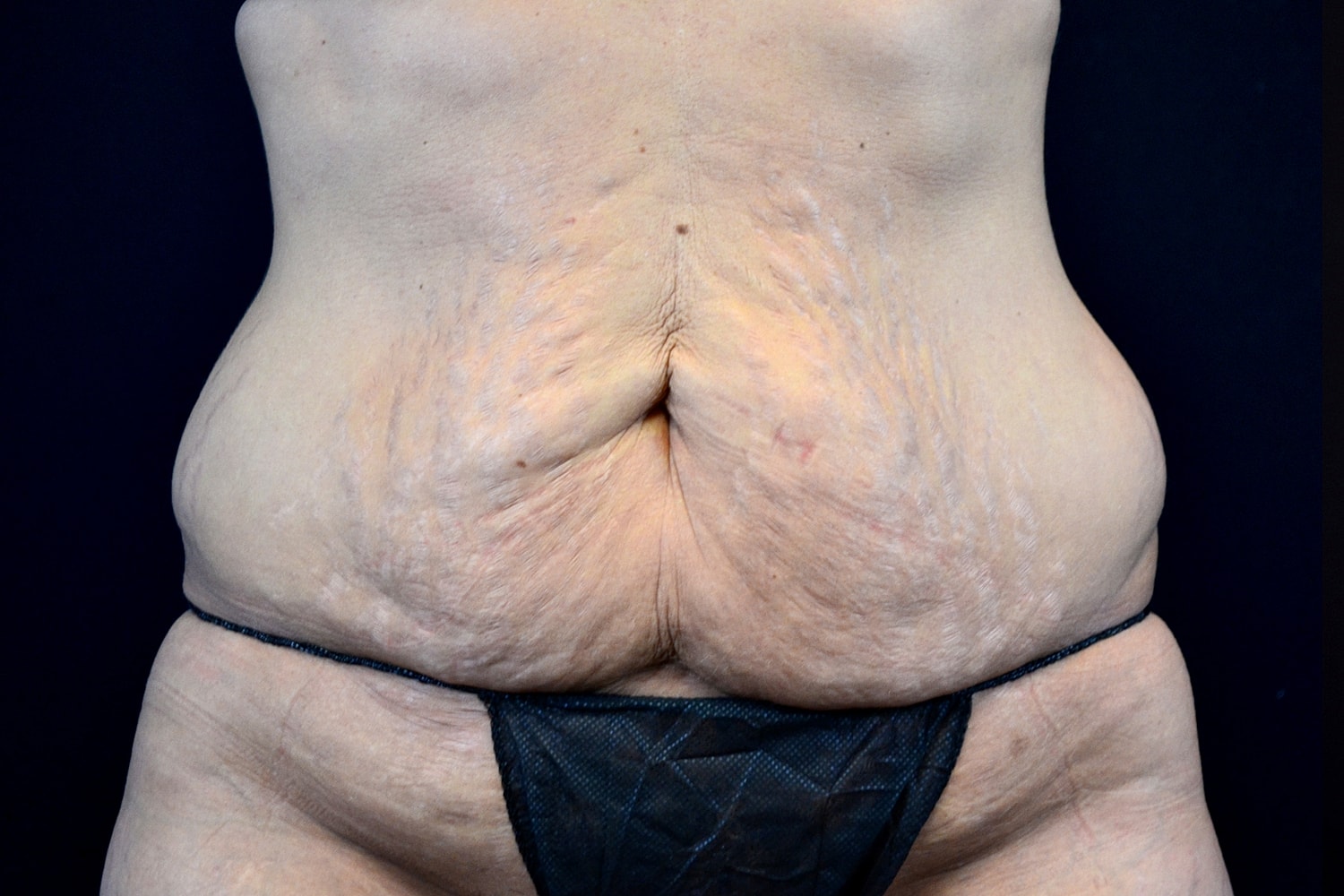 Tummy Tuck Before & After