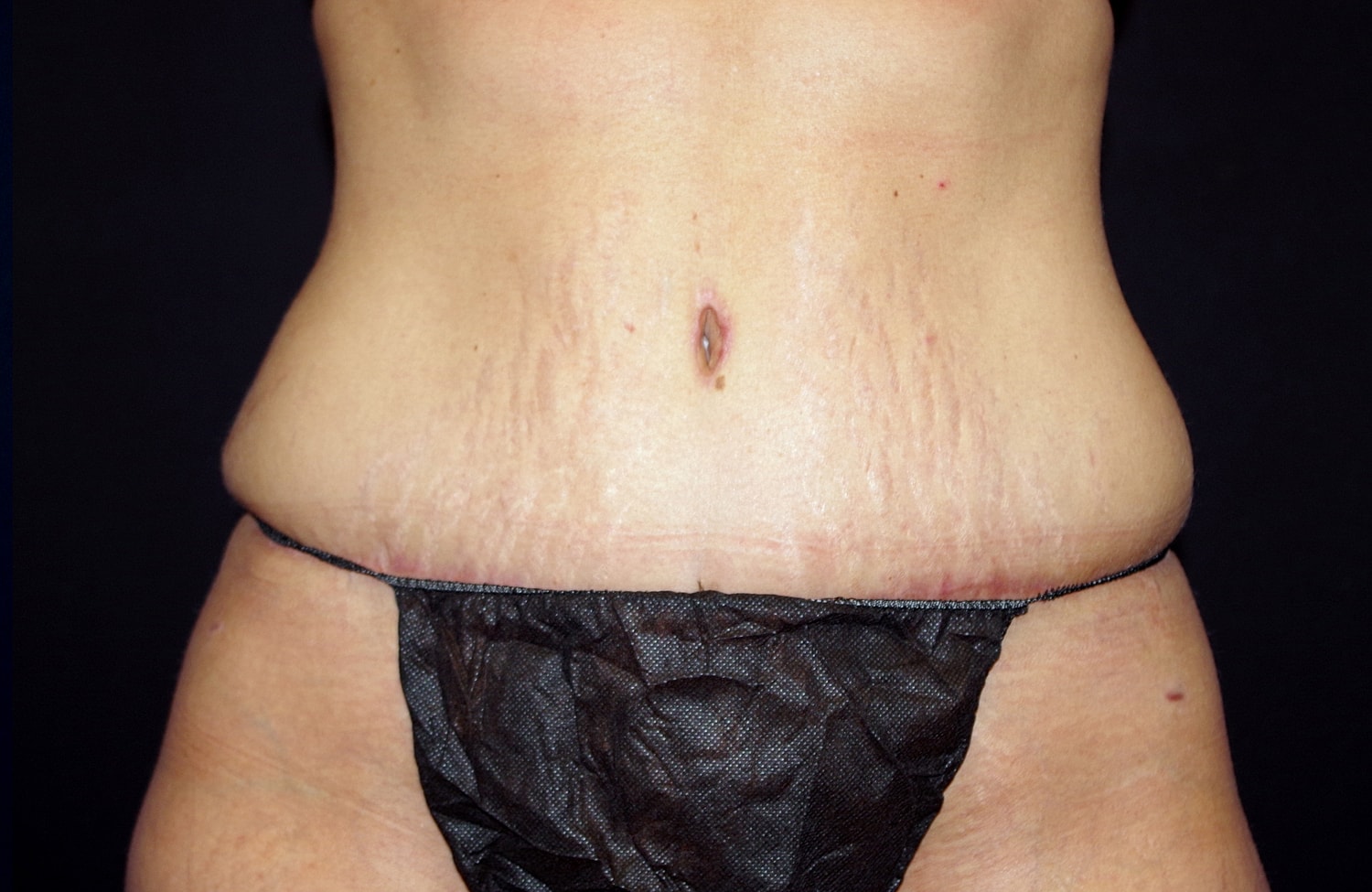 Tummy Tuck Before & After