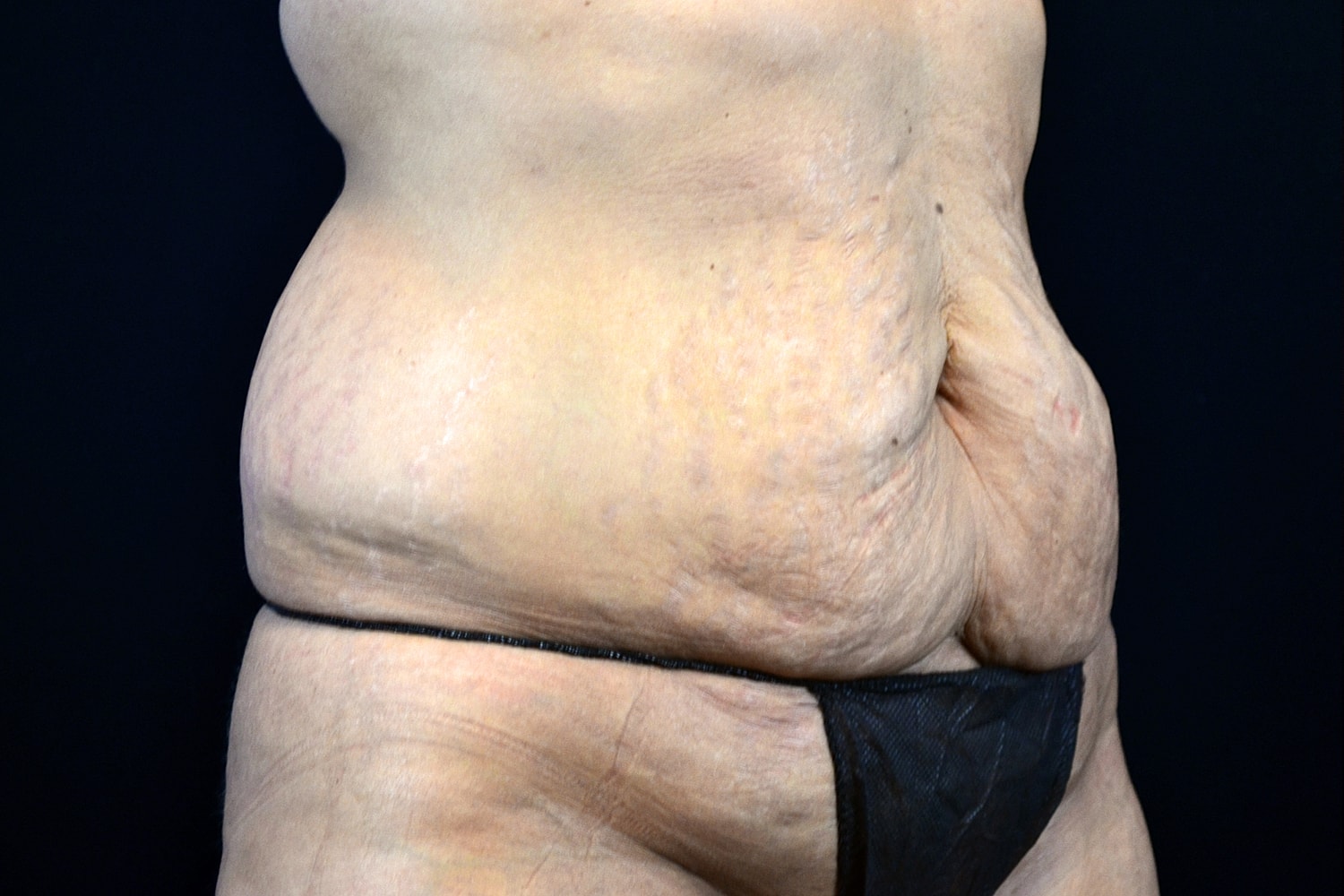 Tummy Tuck Before & After
