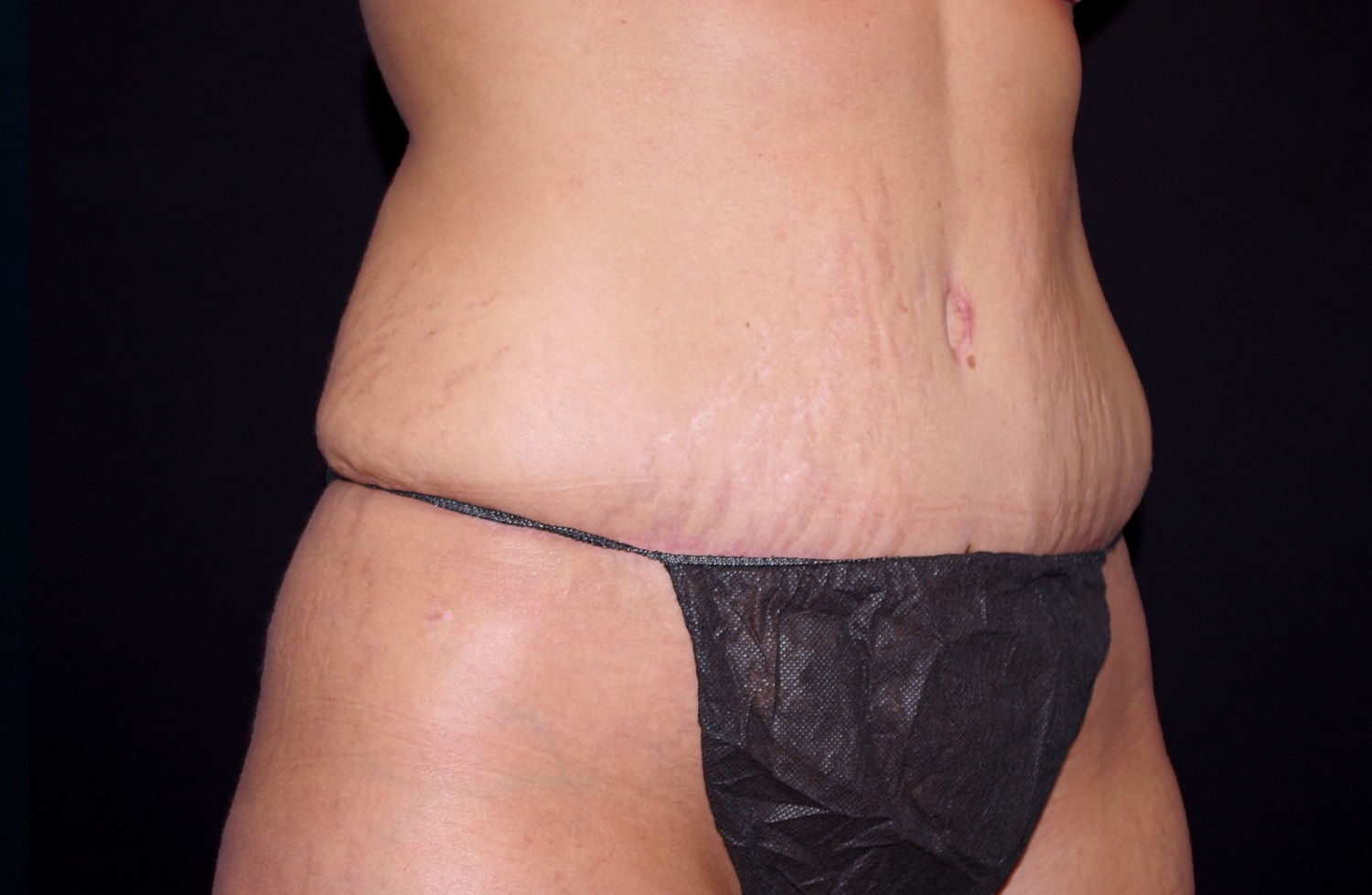 Tummy Tuck Before & After