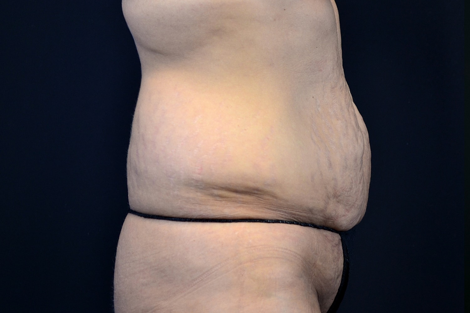 Tummy Tuck Before & After