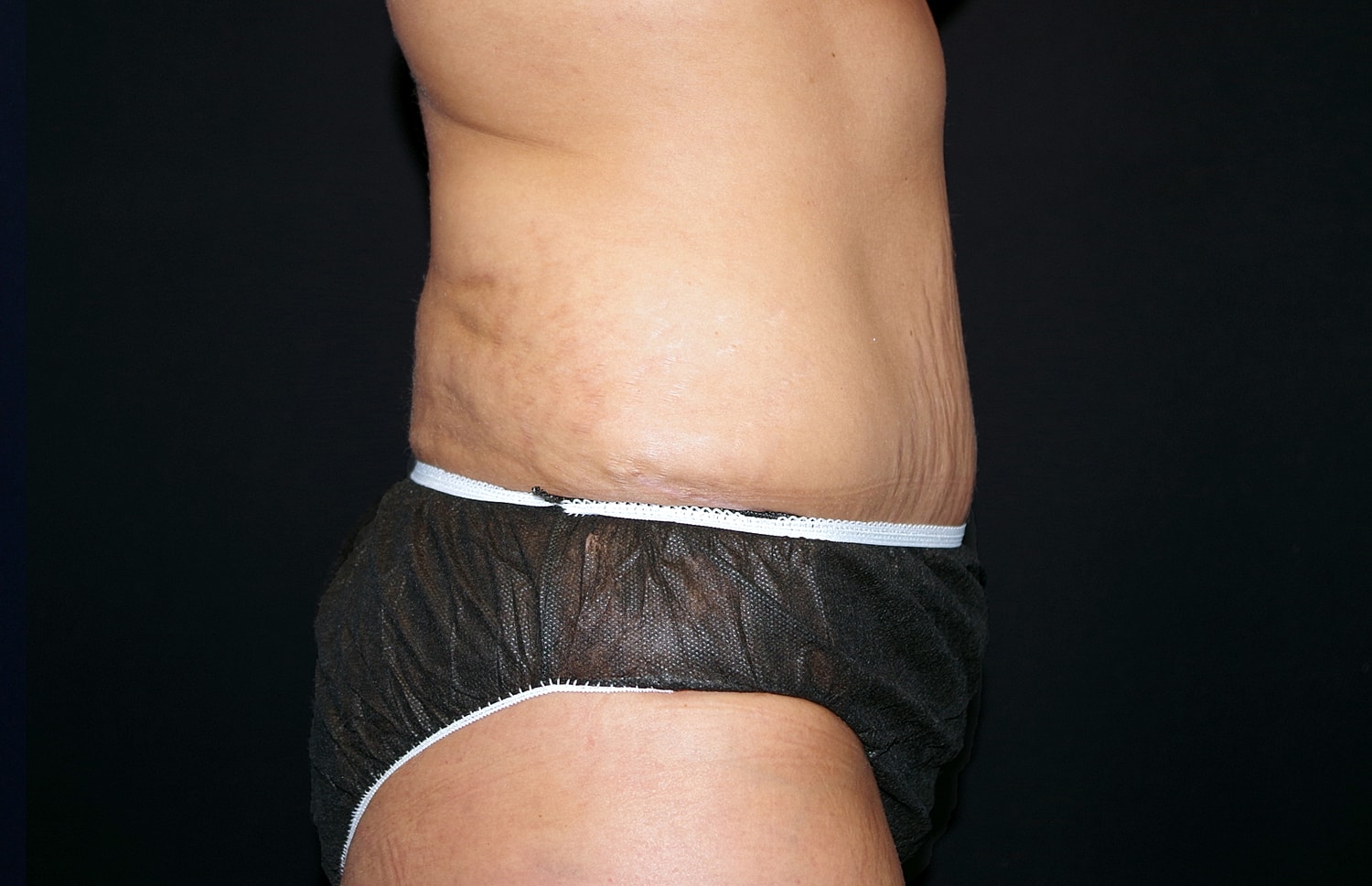 Tummy Tuck Before & After