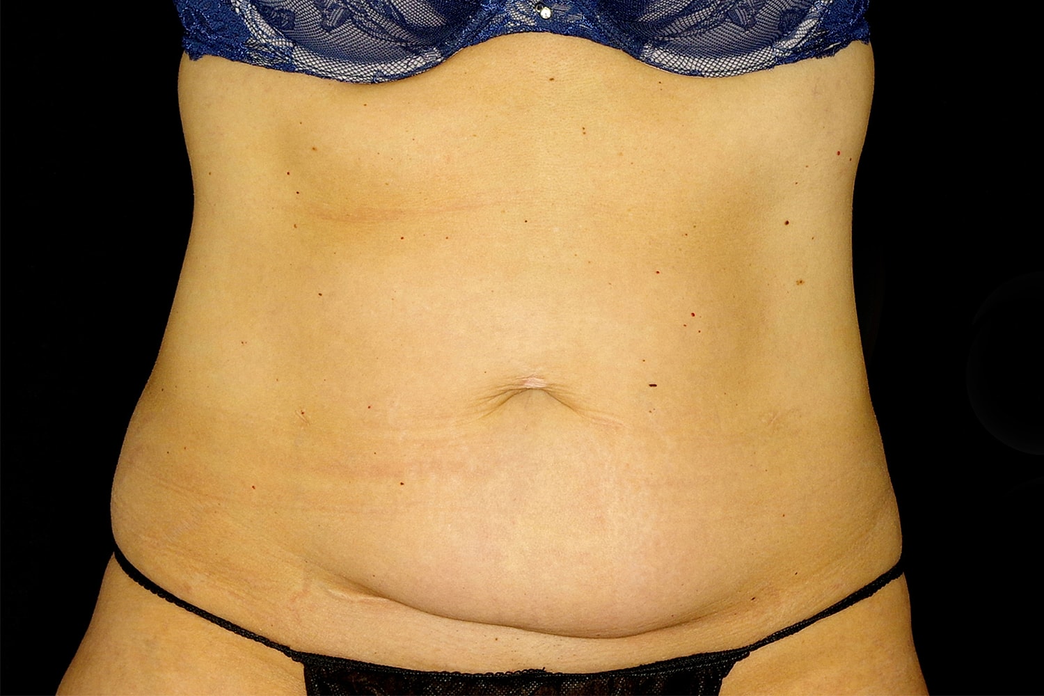 Tummy Tuck Before & After