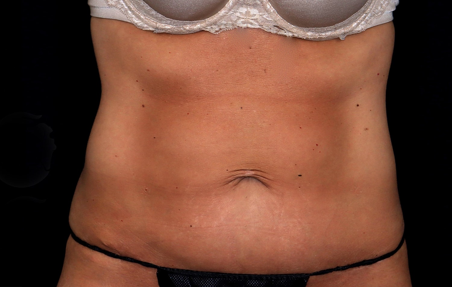 Tummy Tuck Before & After
