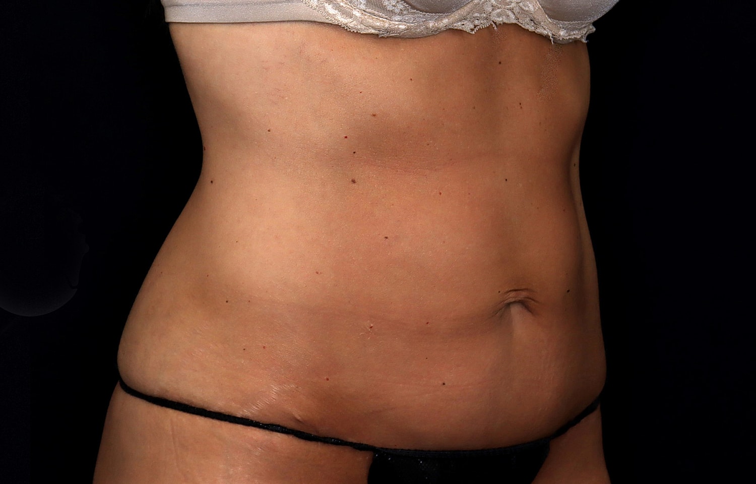 Tummy Tuck Before & After