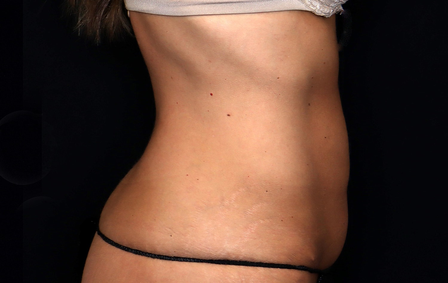 Tummy Tuck Before & After