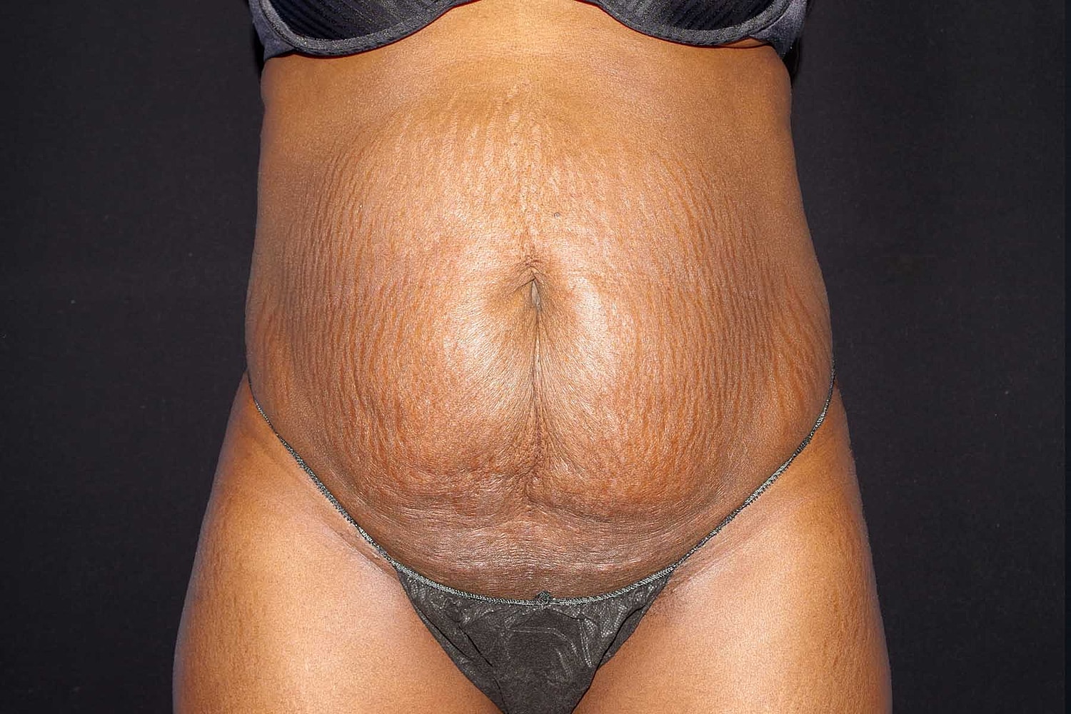Tummy Tuck Before & After