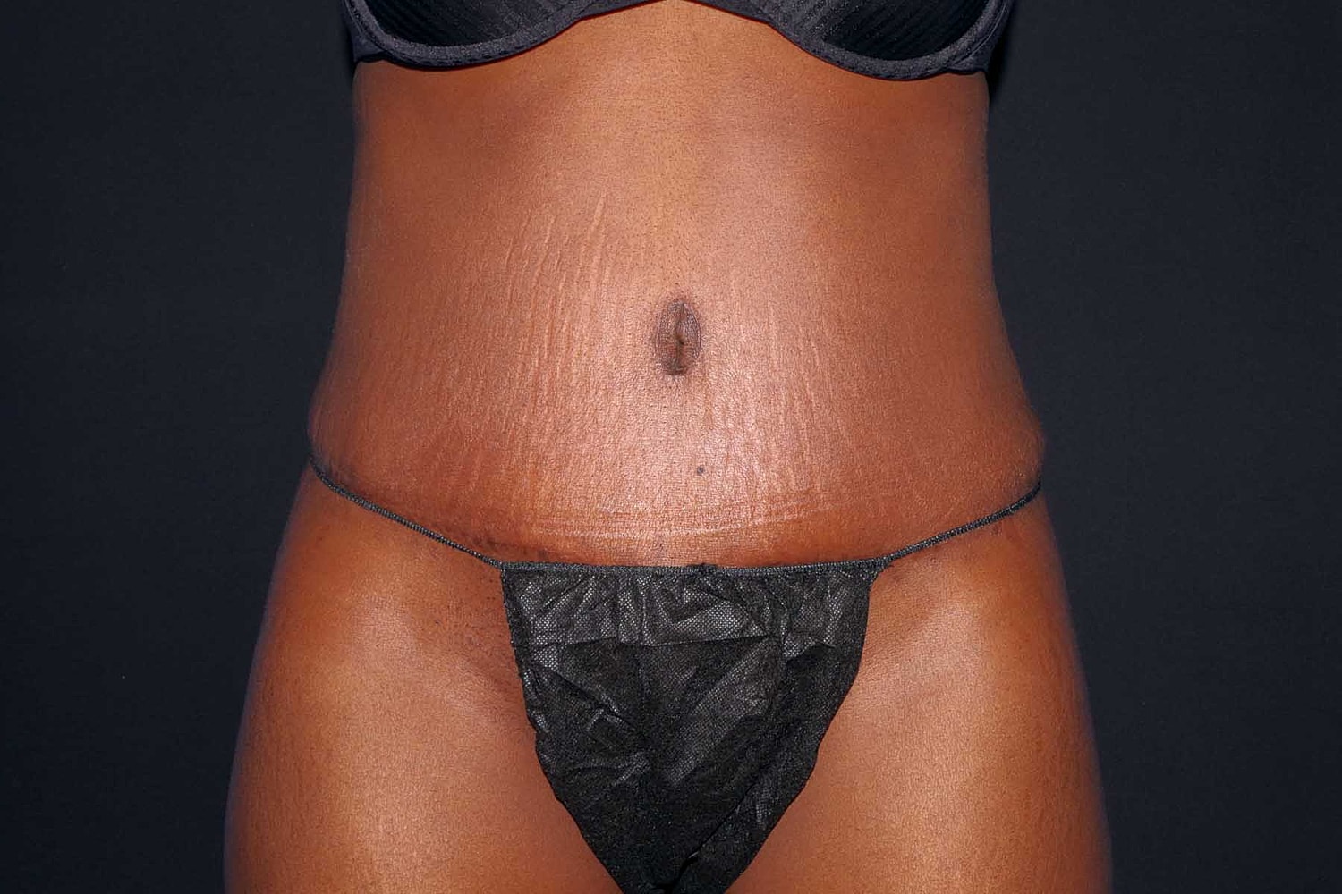 Tummy Tuck Before & After