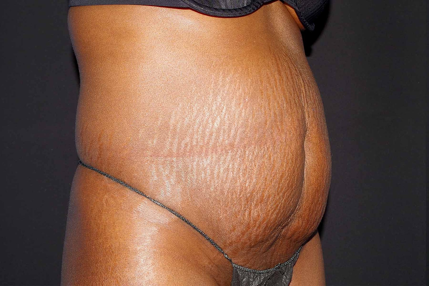 Tummy Tuck Before & After