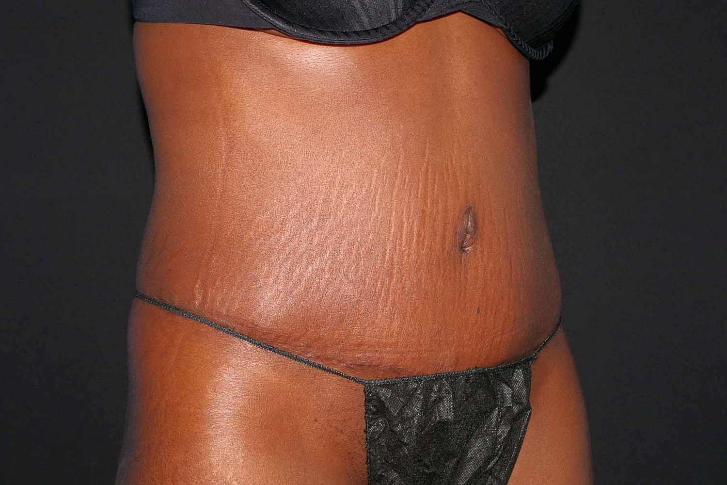 Tummy Tuck Before & After