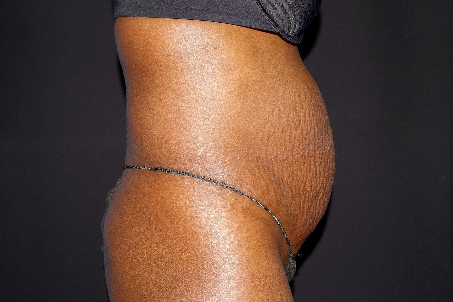 Tummy Tuck Before & After