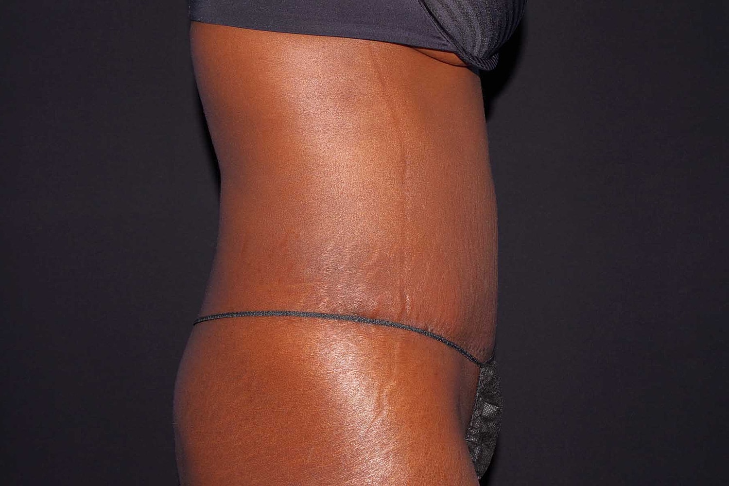 Tummy Tuck Before & After