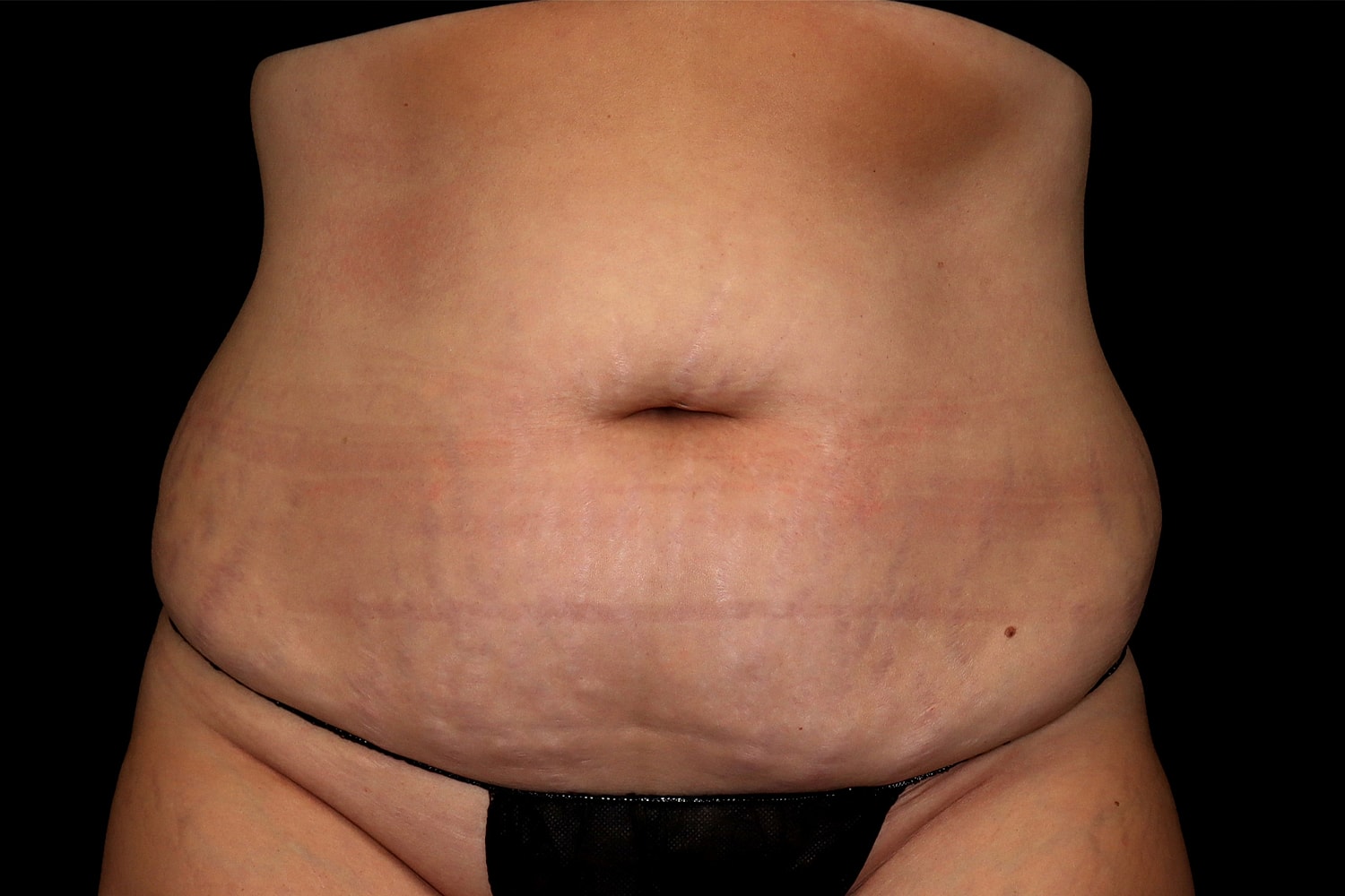 Tummy Tuck Before & After