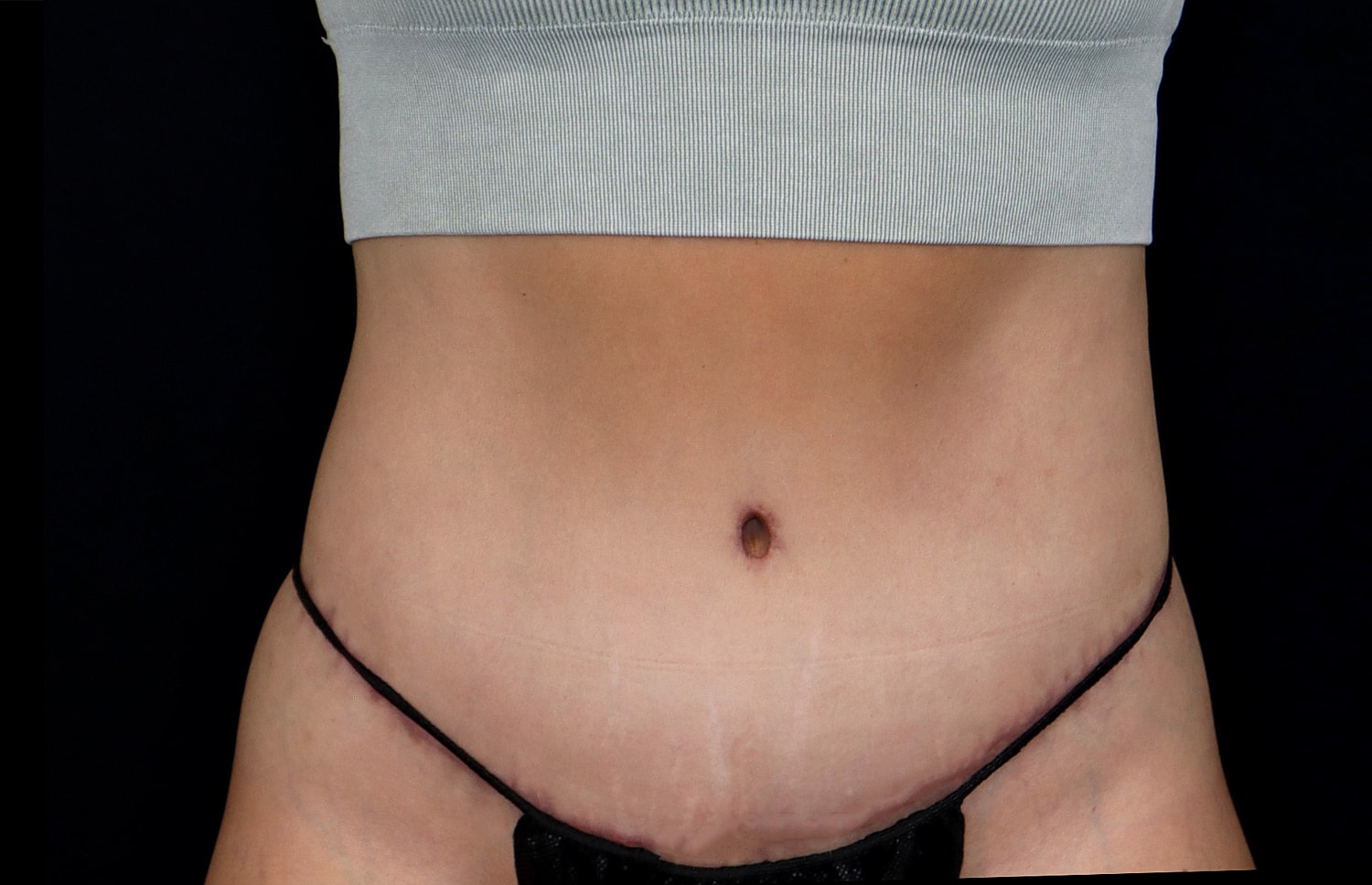 Tummy Tuck Before & After