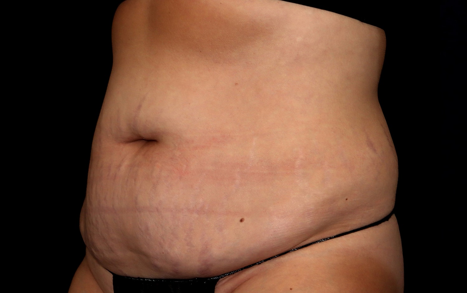 Tummy Tuck Before & After