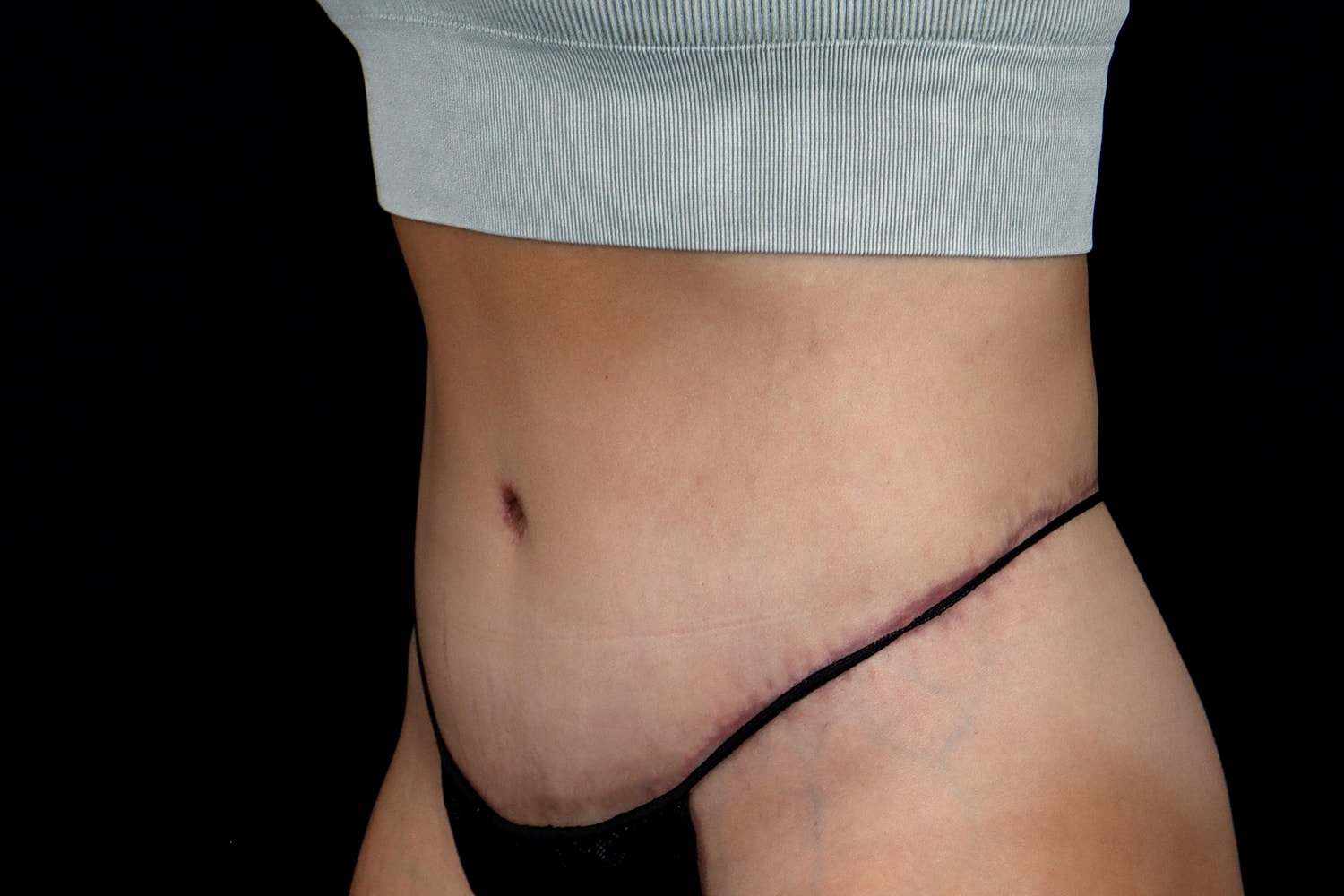Tummy Tuck Before & After