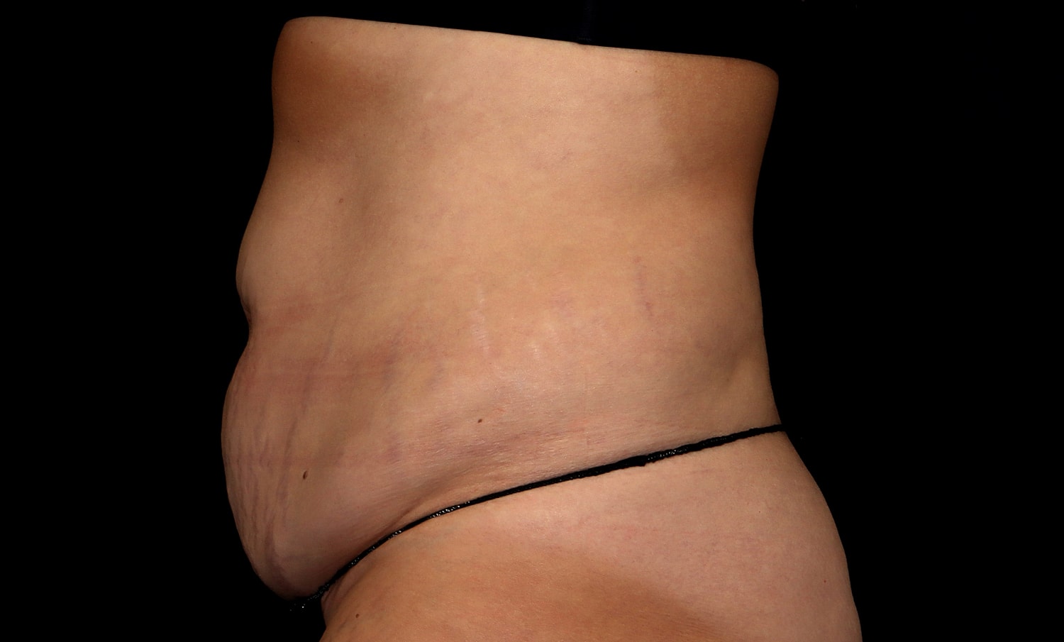 Tummy Tuck Before & After