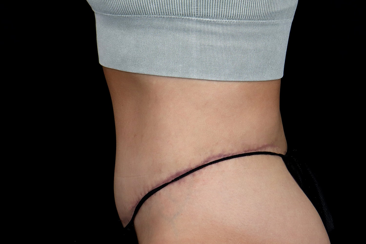 Tummy Tuck Before & After