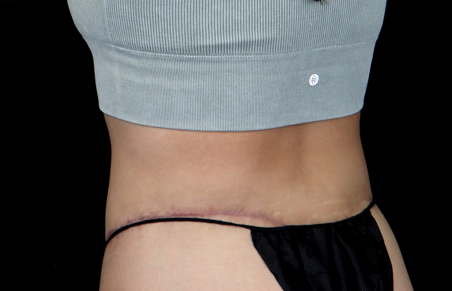 Tummy Tuck Before & After