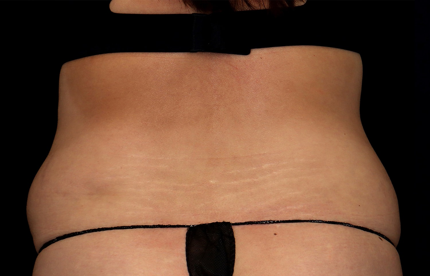 Tummy Tuck Before & After