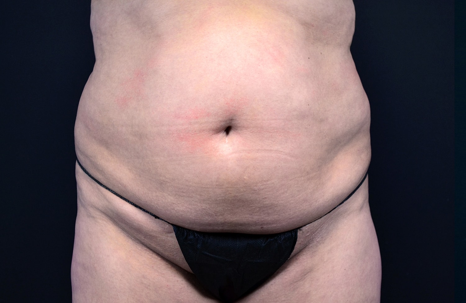 Tummy Tuck Before & After