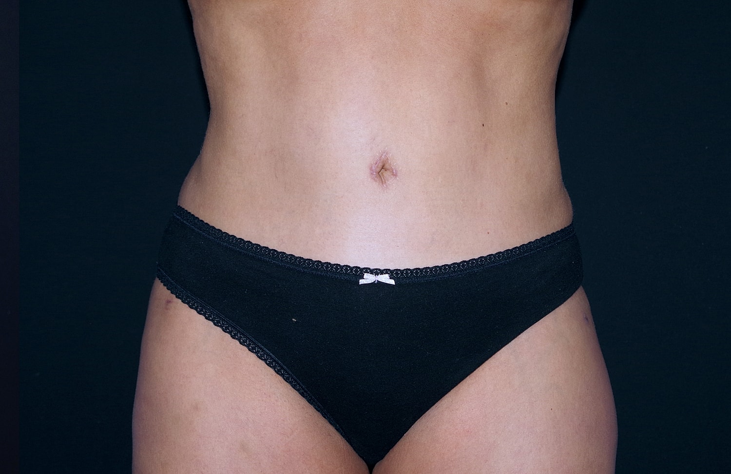 Tummy Tuck Before & After