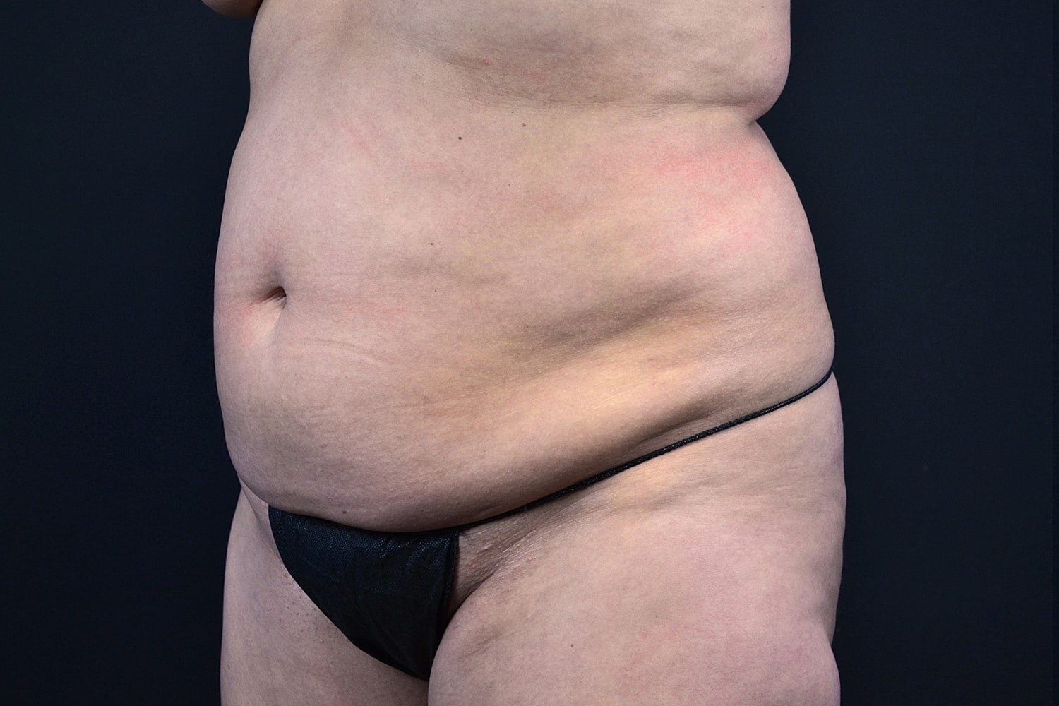 Tummy Tuck Before & After