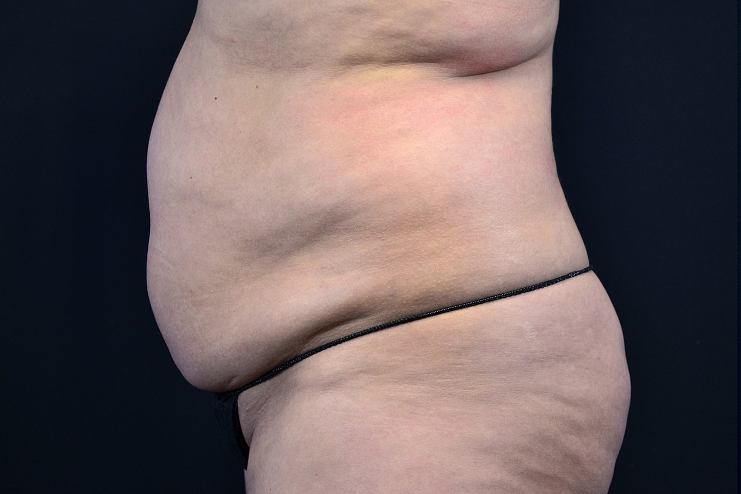 Tummy Tuck Before & After