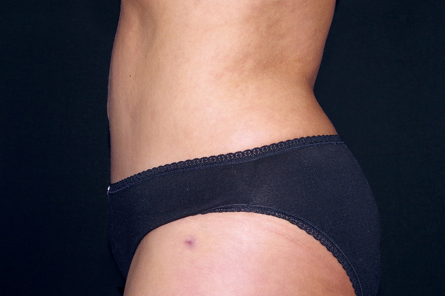 Tummy Tuck Before & After