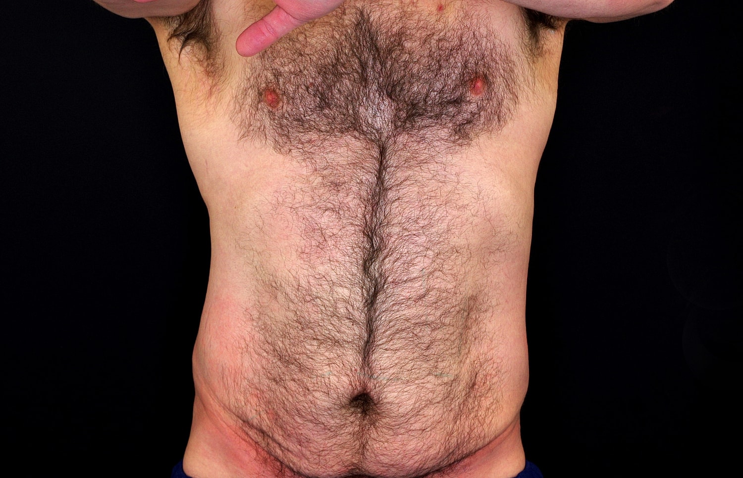 Tummy Tuck Before & After