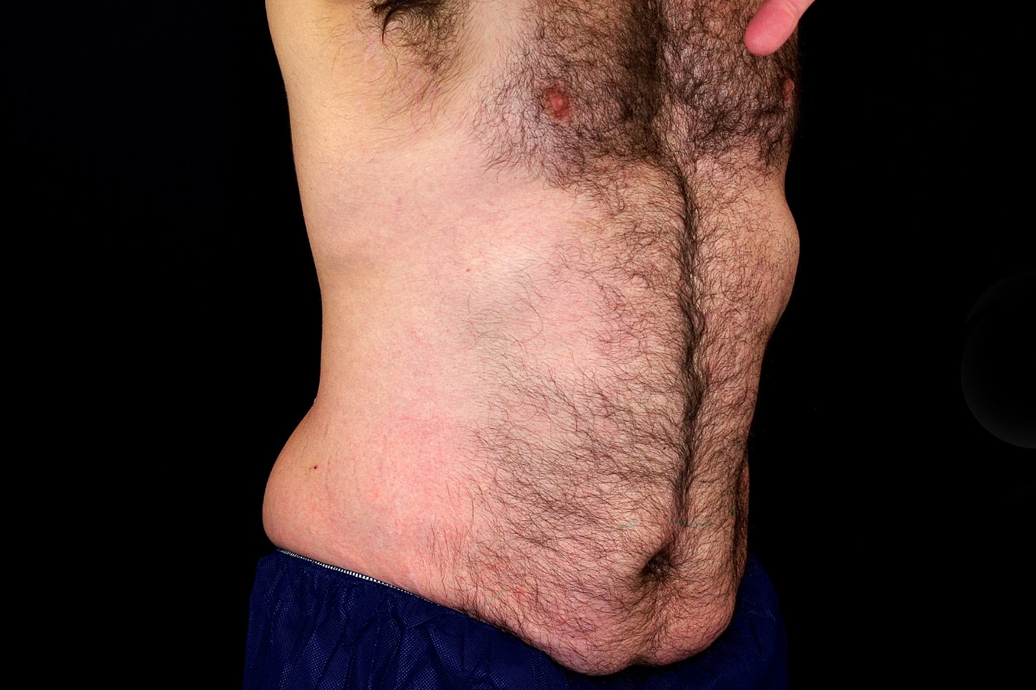 Tummy Tuck Before & After