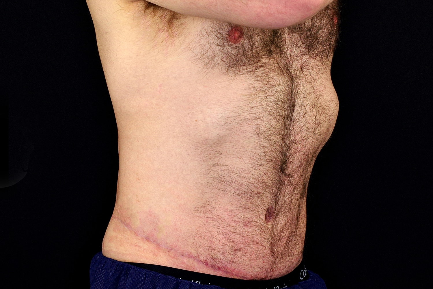 Tummy Tuck Before & After