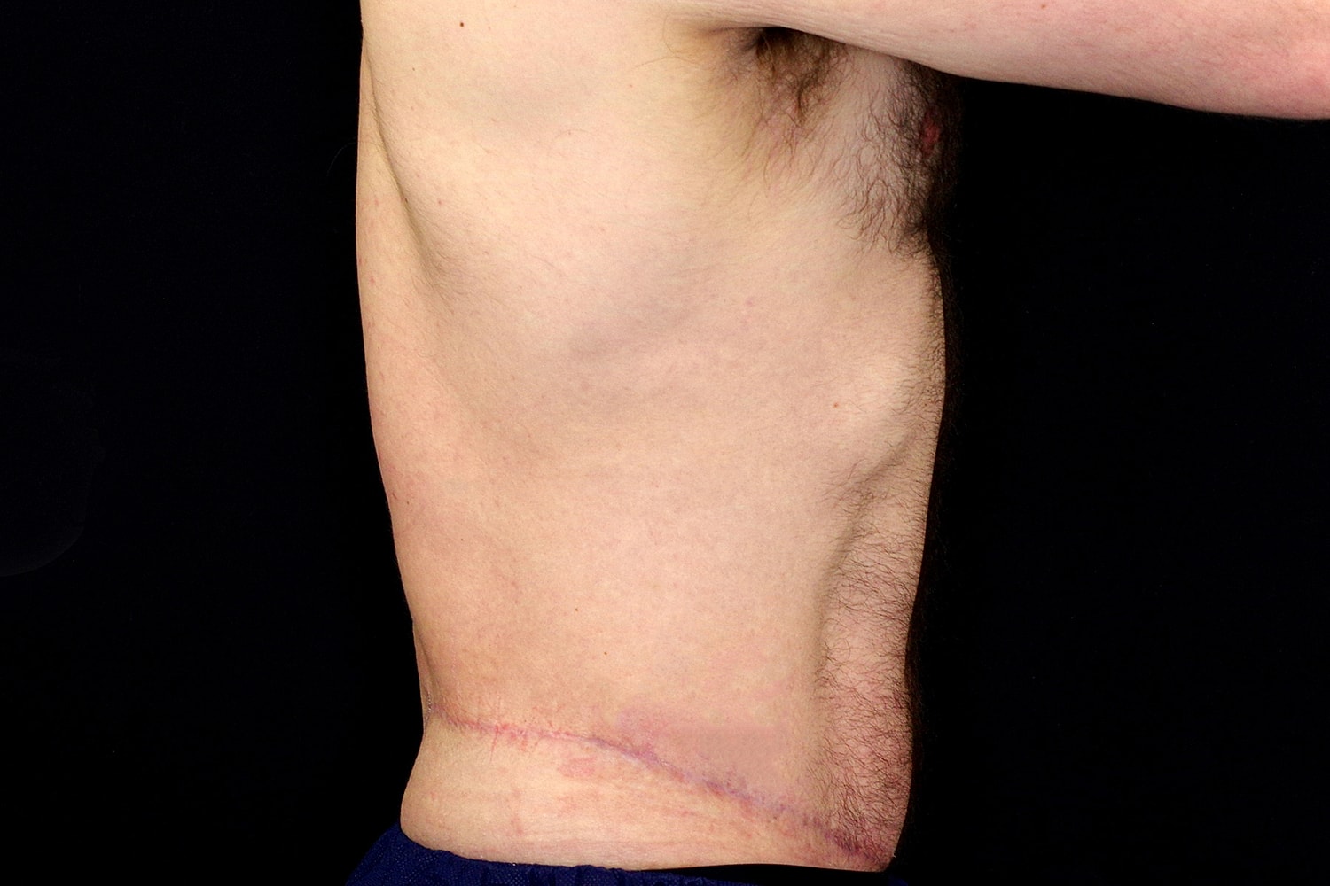 Tummy Tuck Before & After