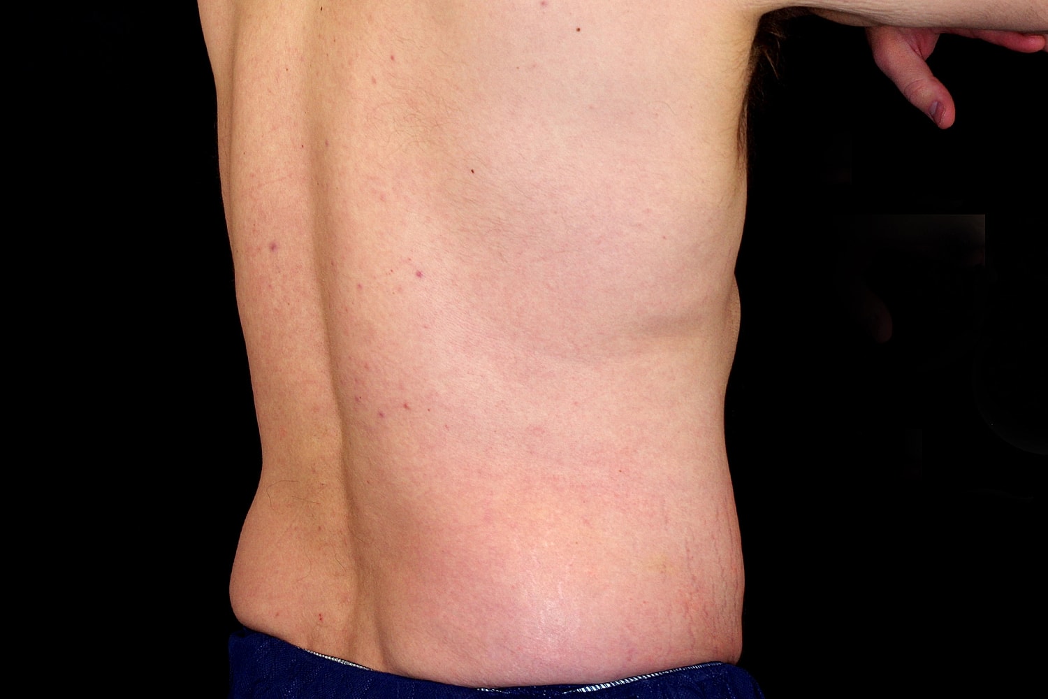 Tummy Tuck Before & After