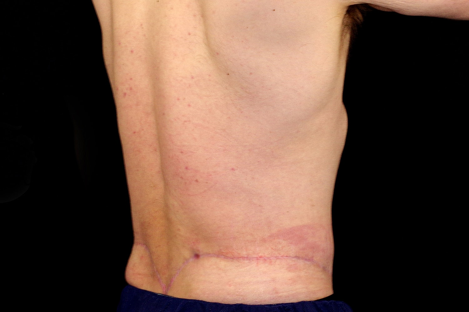 Tummy Tuck Before & After
