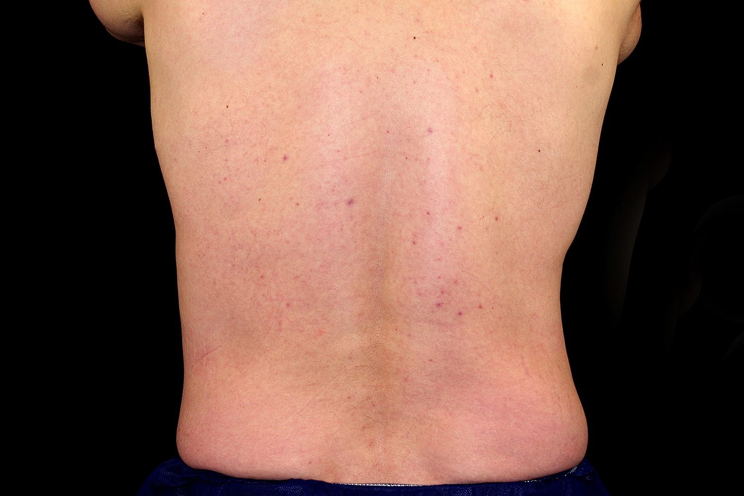 Tummy Tuck Before & After