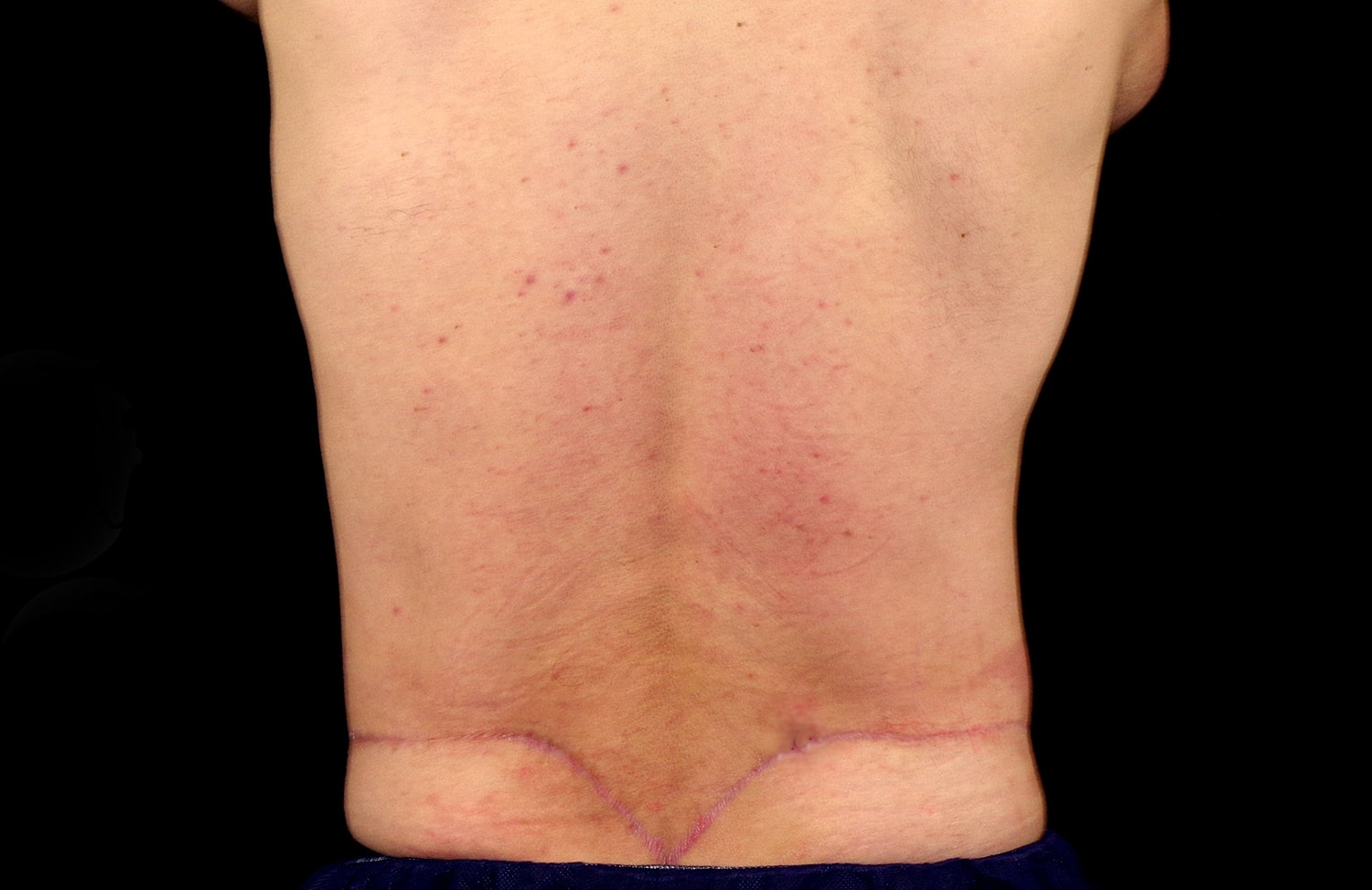 Tummy Tuck Before & After