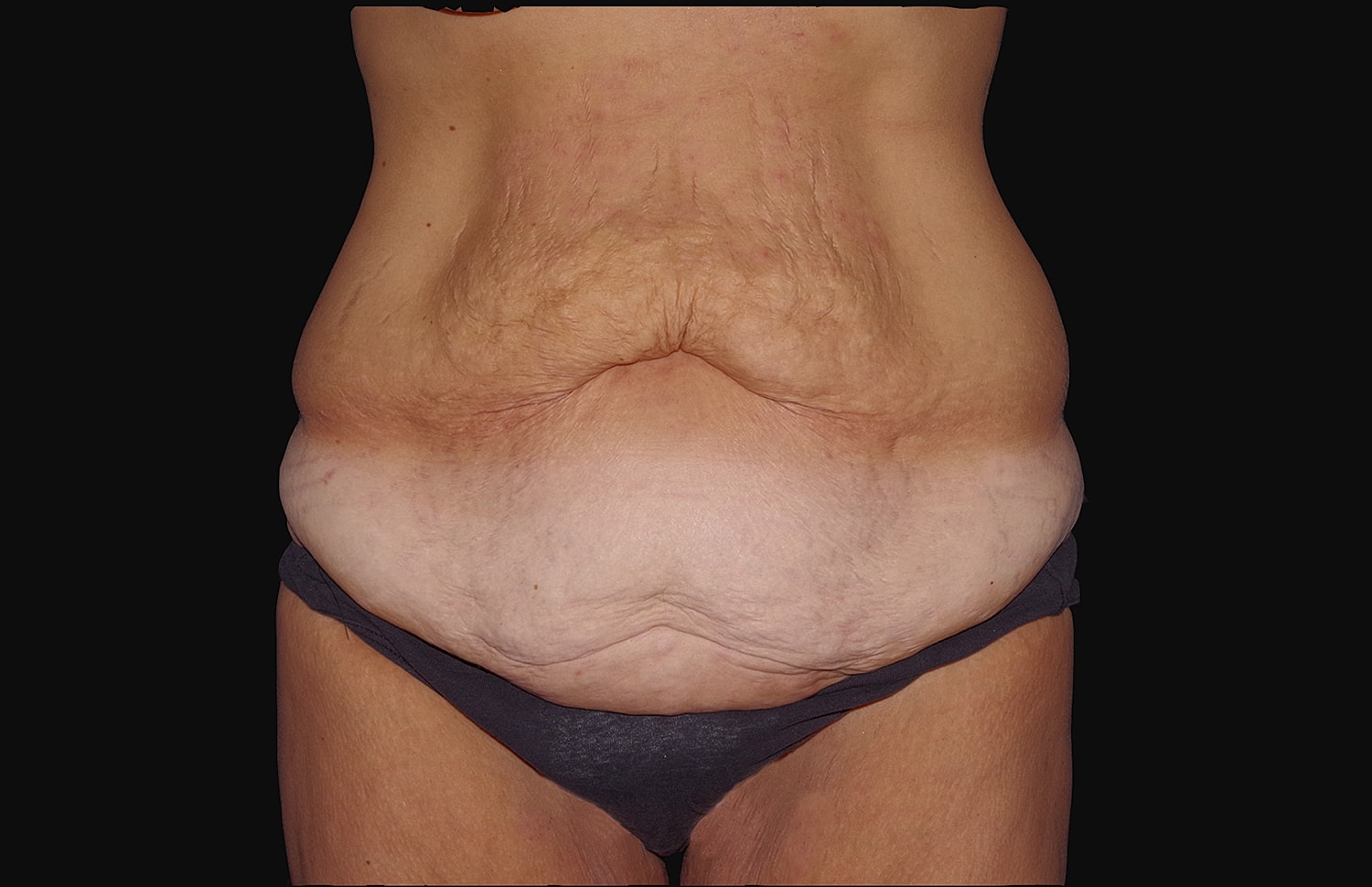 Tummy Tuck Before & After