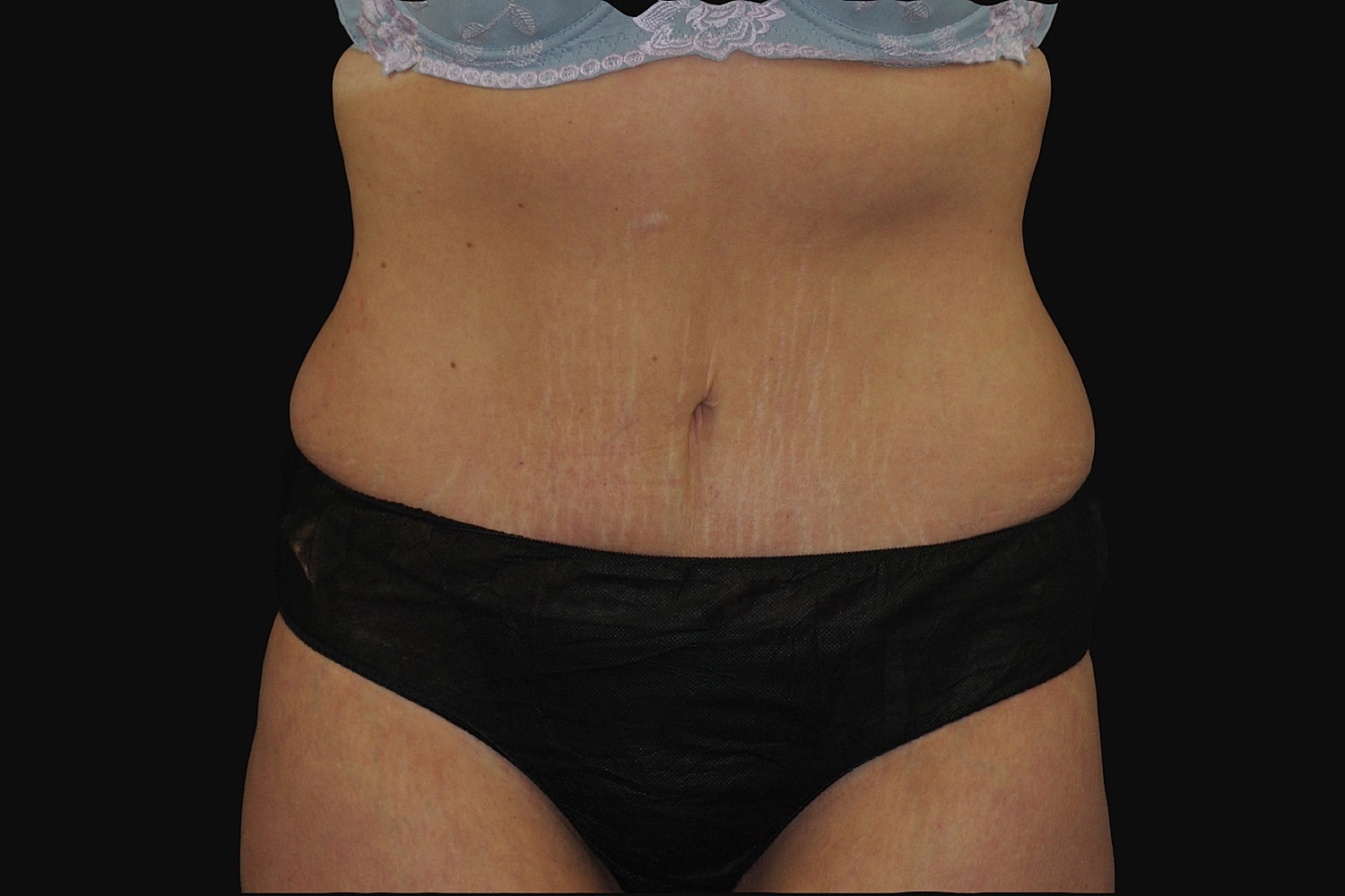 Tummy Tuck Before & After