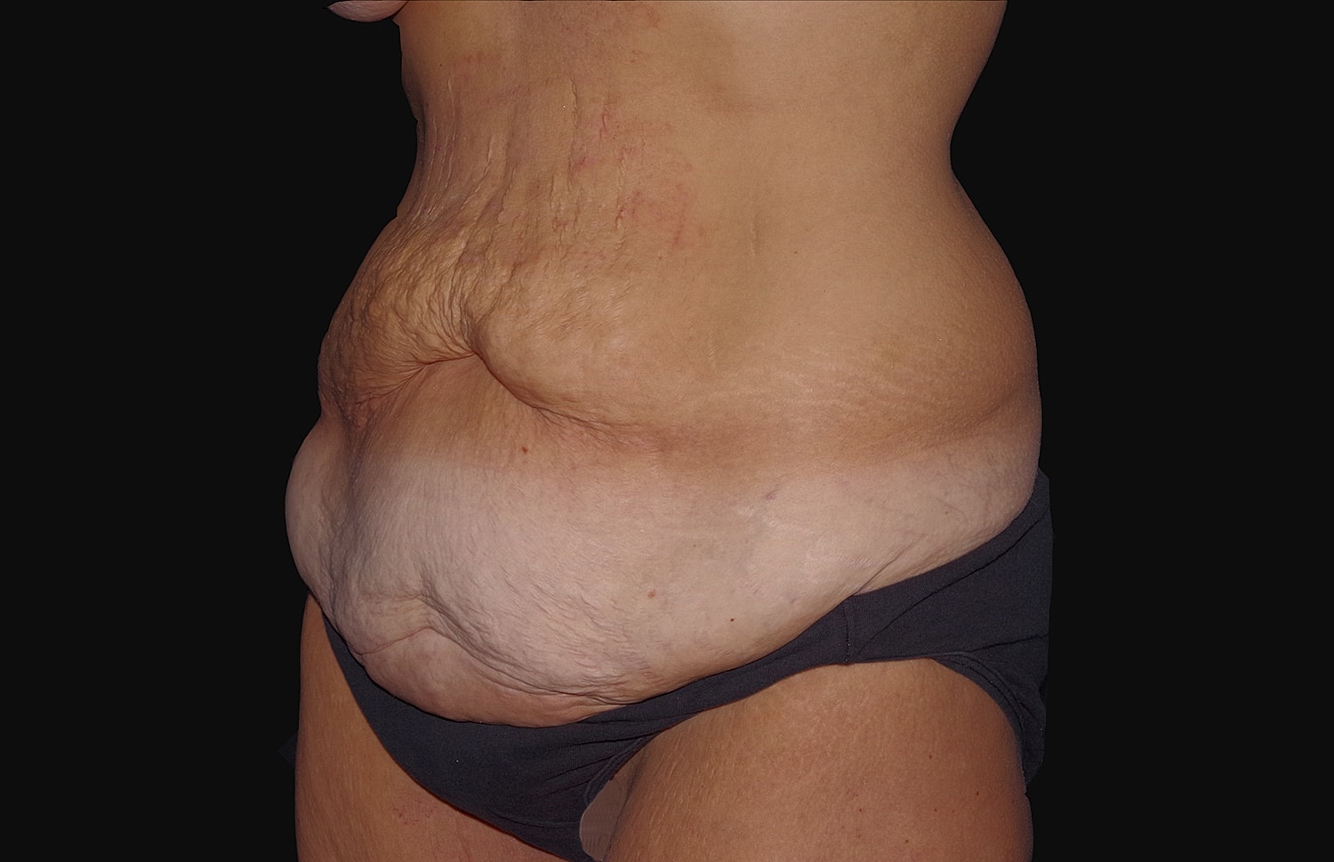 Tummy Tuck Before & After