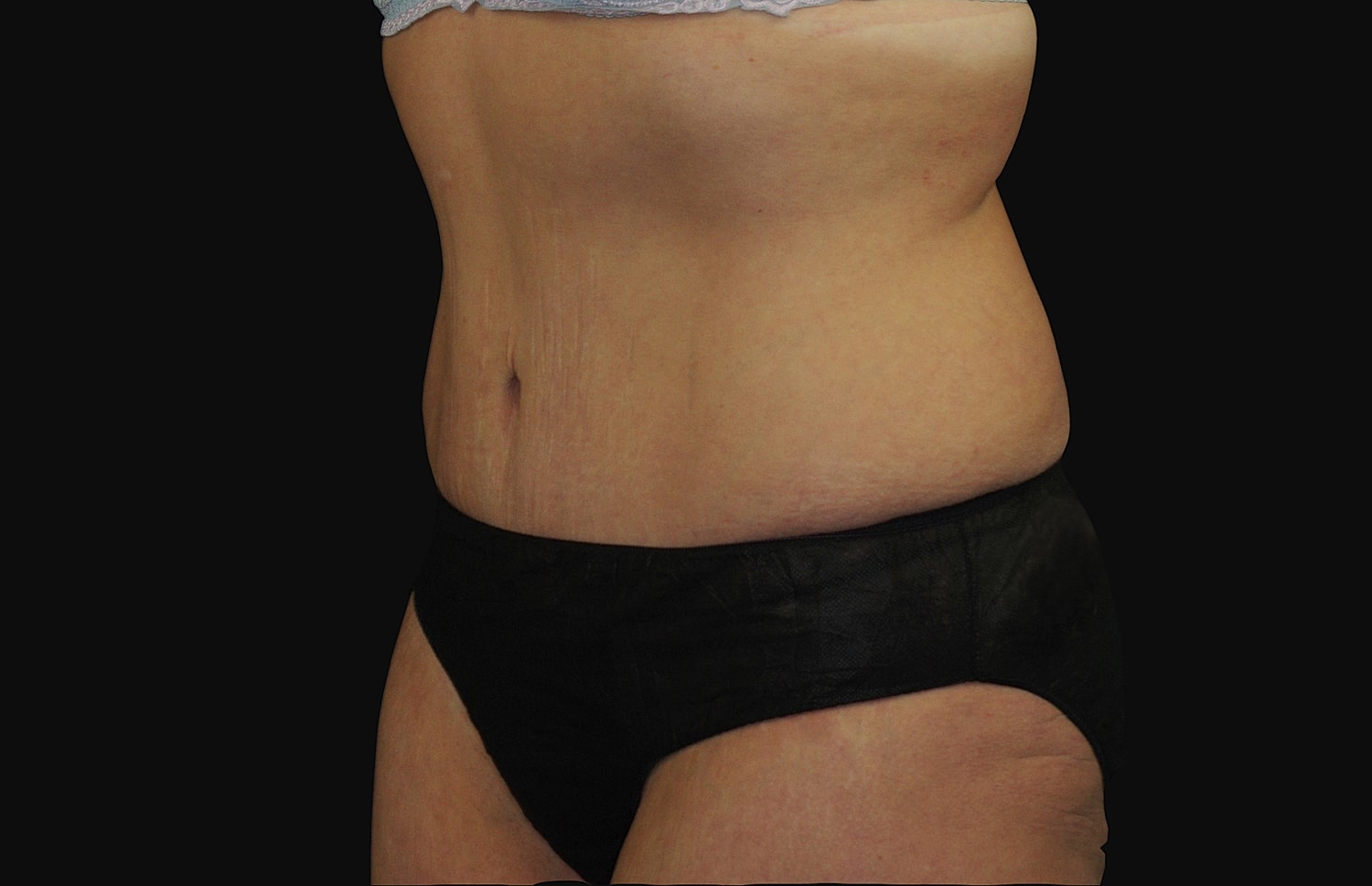 Tummy Tuck Before & After