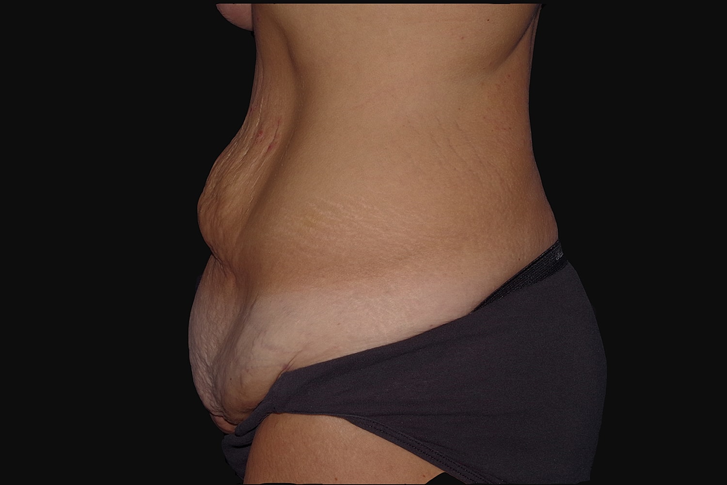 Tummy Tuck Before & After