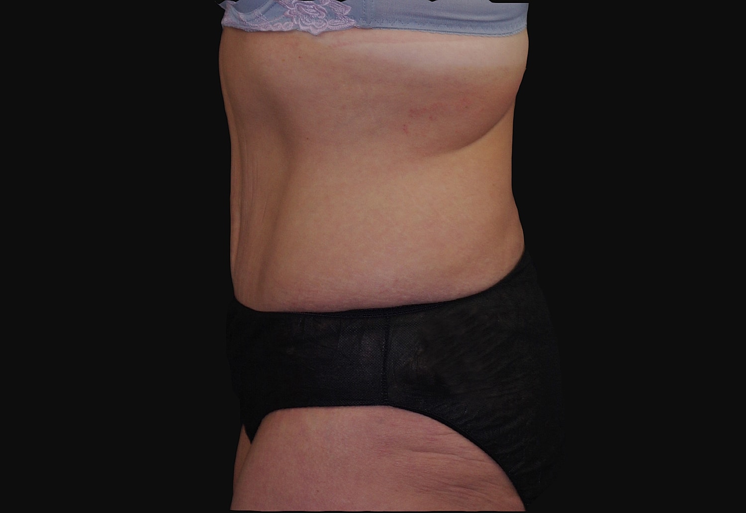 Tummy Tuck Before & After