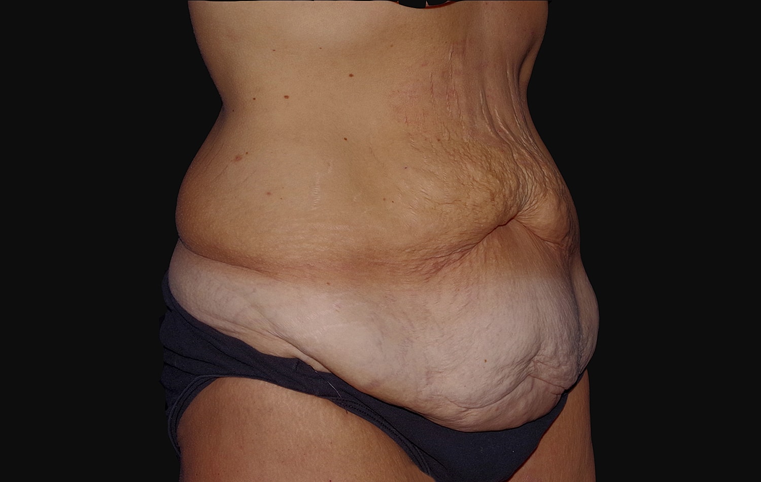Tummy Tuck Before & After