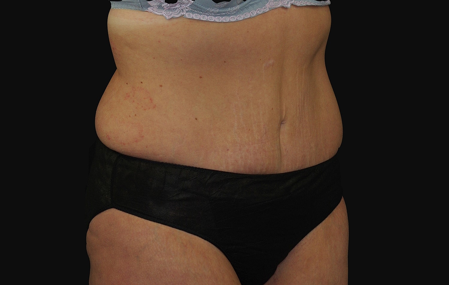 Tummy Tuck Before & After